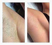 Фото До и После 5