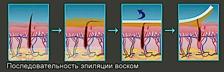 Последовательность эпиляции