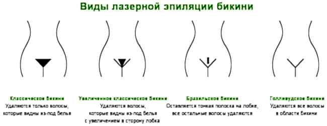 Виды эпиляции