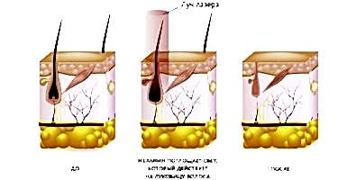 Методы электроэпиляции