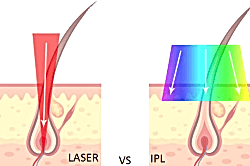 Обучение лазерной эпиляции 