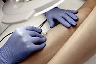 Курсы электроэпиляции