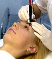 Электроэпиляция лица